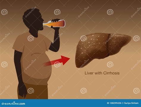 Liver With Cirrhosis Inside Human Body Royalty Free Illustration CartoonDealer Com