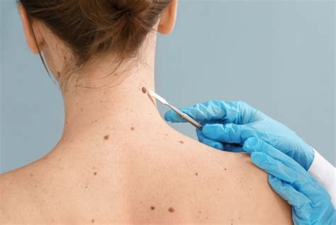 Safe And Effective Mole Removal Near Me Pulse Light Clinic London