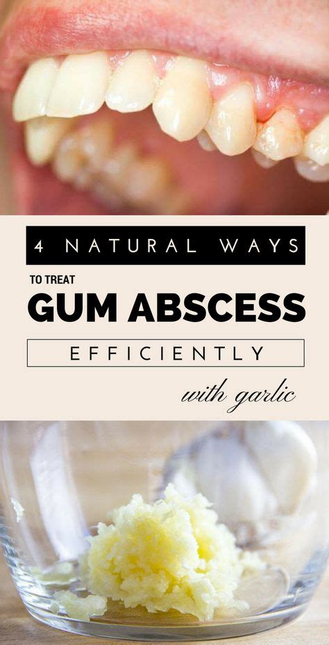 4 Natural Ways To Treat Gum Abscess Efficiently With Garlic Womendiva