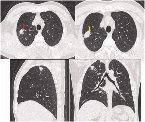 Clinical Features And Radiological Characteristics Of Pulmonary