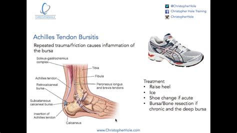 Injuries And Rehab Achilles Tendon Bursitis Youtube