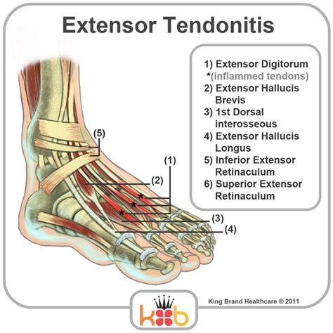 Extensor Tendonitis Top Of Foot Pain On Top Of Foot Causes Symptoms