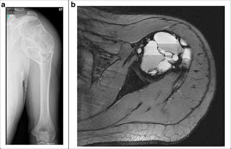 Aneurysmal Bone Cyst Of The Proximal Humerus A Ap X Ray Humerus