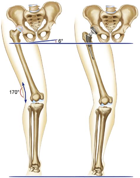 Knee Valgus Deformity Kv Was Defined As Femoral Tibial Angle Of 170