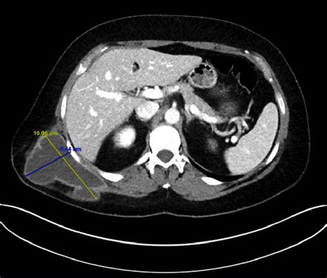 Ct Scan Of Abdomen Pelvis With Iv Contrast Showing Fluid Collection