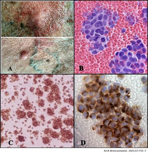 Merkel Cell Carcinoma With Pleural Effusion Archivos De Bronconeumología