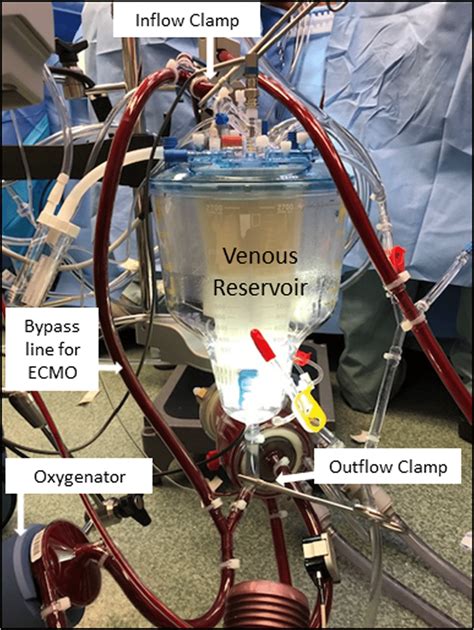 Intraoperative Photograph Of The Hybrid Circuit During Ecmo Used With