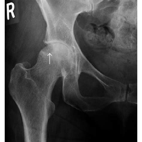 A Ap Radiograph Of The Right Hip A Focal Area Of Subchondral Lucency