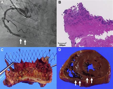 Coronary Embolism Secondary To Prosthetic Valve Endocarditis After