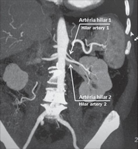 Multidetector Computed Tomography Angiography Of The Renal Arteries