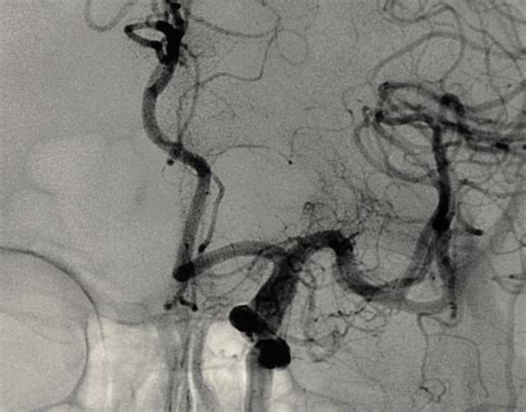 Cerebral Angiography