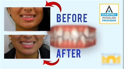 Invisalign Before And After Crowded Teeth Youtube