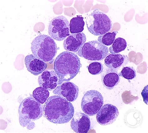 Chronic Myelomonocytic Leukemia 3