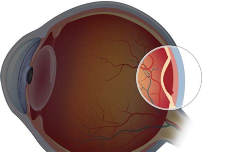 Detached retina retinal detachments may require surgery to return the retina to its proper position in the back of the eye. Retinal Detachment Surgery