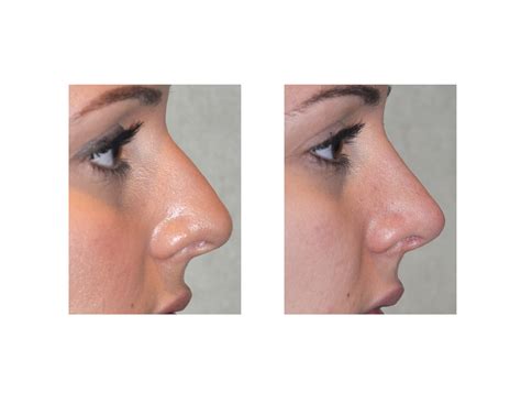 Greek Nose Shape
