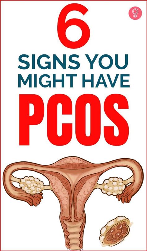 Signs You Might Have Polycystic Ovary Syndrome Artofit
