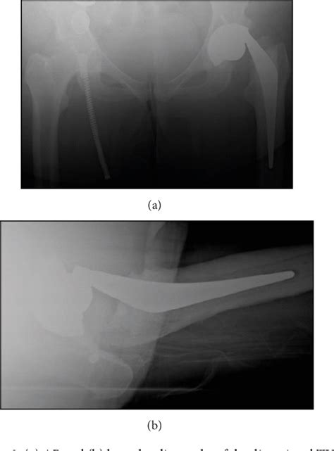 Pdf Late Nontraumatic Dissociation Of The Femoral Head And Trunnion