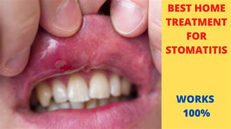 Stomatitis In Mouthoral Mucositisstomatitis Treatment 2020 Youtube