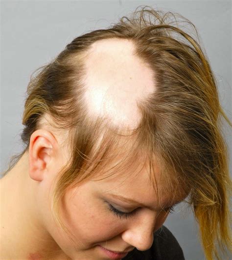 Hair Loss Center Type Causes Prevention And Treatments