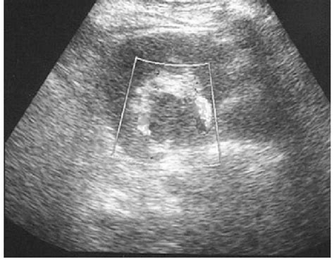 Transverse Scan Of The Left Kidney Showing A Hypoechoic Mass With No