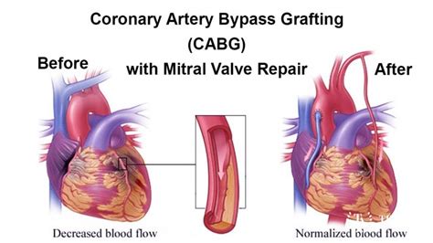 Combined Heart Valve Replacement And Coronary Artery Bypass Surgery