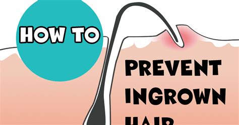 How To Properly Remove Ingrown Hair