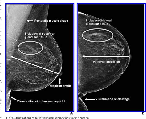 Figure 1 From Mammography Positioning Standards In The Digital Era Is The Status Quo Acceptable