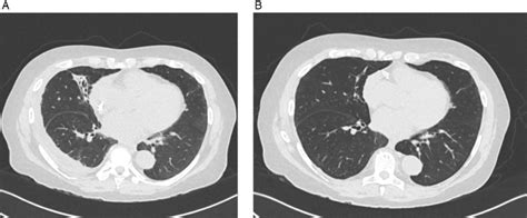 Computed Tomography Ct Chest Showing Right Middle Lobe Collapse Prior