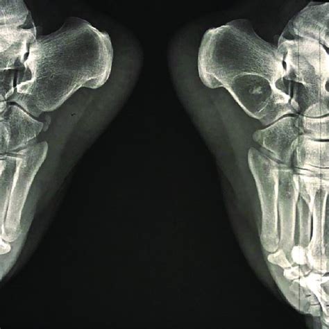 Lateral View Of The Plain Radiograph Of The Foot Right And Left