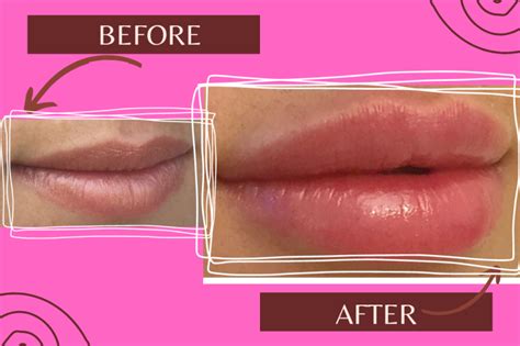 How The Subtle Lip Filler That Makes Your Lips Look Amazing Thetimetips
