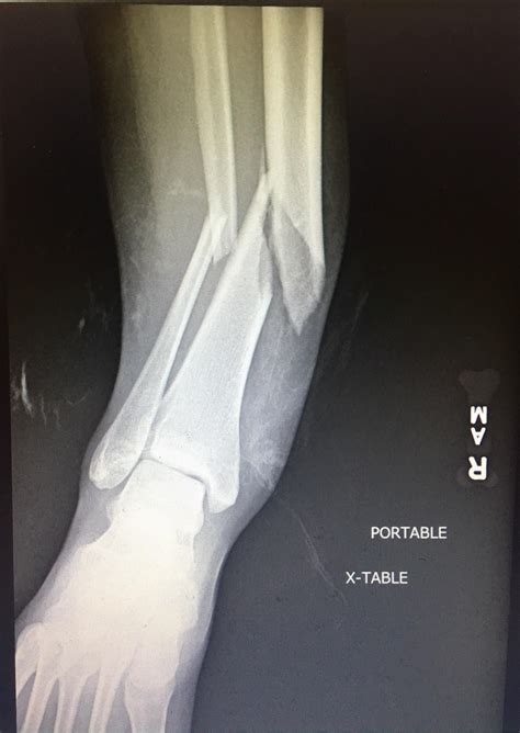Tibia Fracture Mytetechnologies