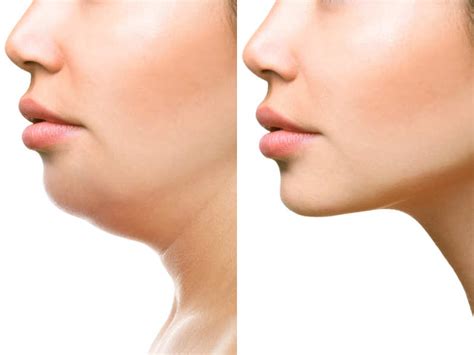 5 Tips To Get Rid Of That Ugly Double Chin The Times Of India
