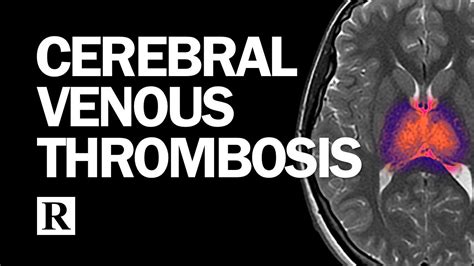 Diagnosis And Management Of Cerebral Venous Thrombosis Youtube