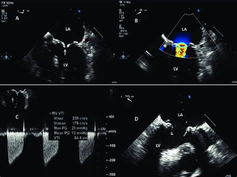Stenosis Of A Bioprosthetic Mitral Valve A Transesophageal