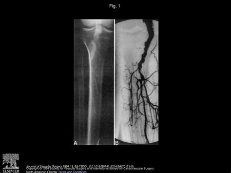 Popliteal Artery Aneurysms Current Management And Outcome Ppt Download