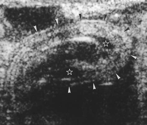 Sonographic Diagnosis Of Neonatal Intussusception With Perforation In A
