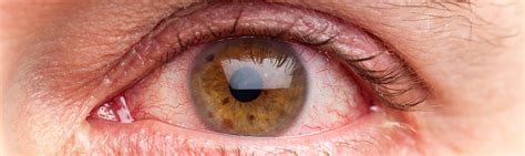 Eye Infections And Injuries L Paragon Ophthalmology