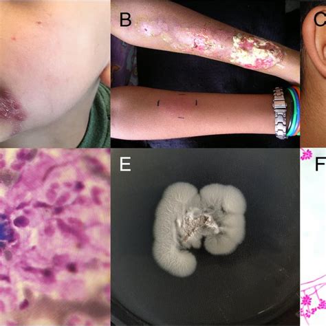 Clinical And Laboratorial Aspects Of Pediatric Sporotrichosis In