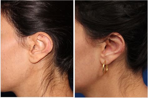 Cosmetic Ear Surgery Troy Mi Andrew Compton Md