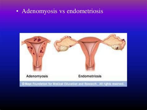 Adenomyosis and endometriosis are at first sight very similar but different conditions. Pelvic pain and differential diagnosis