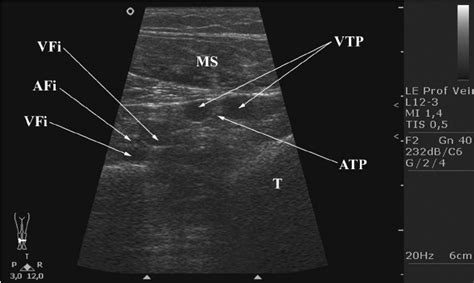 The Ultrasound Image Of The Deep Veins Of Distal Calf Afi Arteria