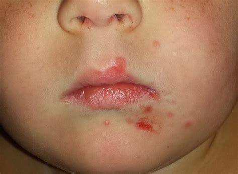 Hand Foot And Mouth Disease Reported