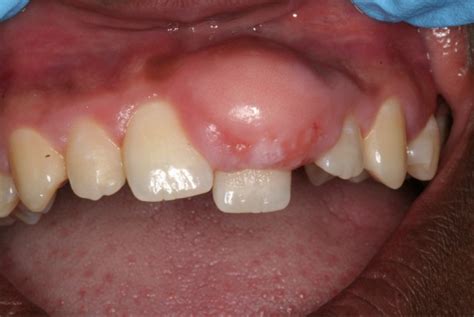 Gum Bumps Oral Path Playbook