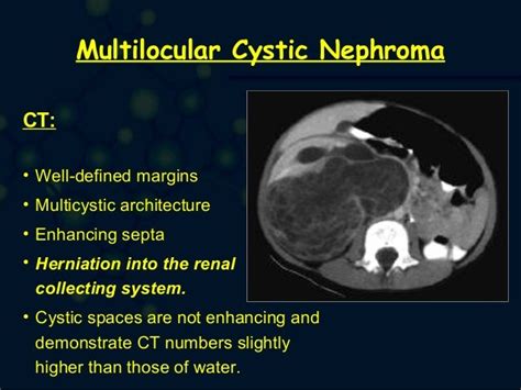 Multilocular Cystic Nephroma