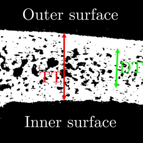 Procedural Steps Of A Parietal Skull Graft Lift Upper Image Sequence