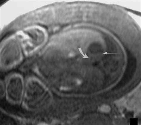 Hemorrhage During Pregnancy Sonography And Mr Imaging Ajr