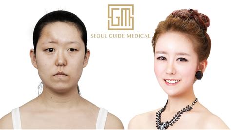 Korean Reconstructive Plastic Surgery Transformation Seoul Guide