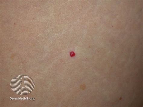 What Are Cherry Angiomas Symptoms Causes Treatments