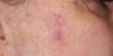 Actinic Keratosis Symptoms Risk Factors And Treatment Scope Heal