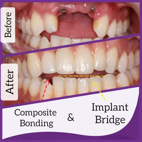 Composite Bonding Fareham Crofton Dental Care